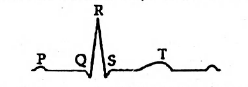 The diagram given here is the standard ECG of a normal person, The P ...